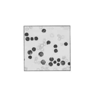 Lukemia, myeloid acute